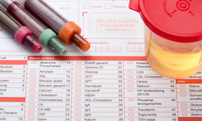 Emoglobina nelle urine: cause, diagnosi e trattamenti